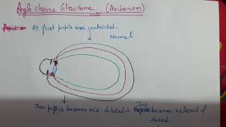 Angle Closure Glaucoma Mechanism  Mid dilation of Pupil  Ophthalmology [upl. by Cockburn]