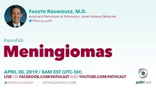 Meningiomas  Dr Rodriguez Hopkins NEUROPATH [upl. by Longmire57]