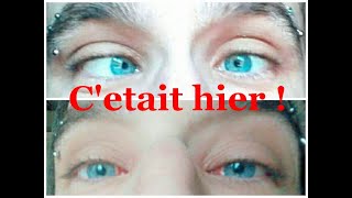 Lendemain doperation du strabismeTOUT VA BIEN strabismus operation [upl. by Akinimod]