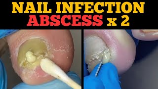 Ingrown Nail Infection Abscess  Second Nail Will Shock You [upl. by Nhoj502]