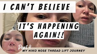 DEALING WITH THREADS REJECTION  HIKO NOSE THREAD LIFT UPDATE [upl. by Iroj]