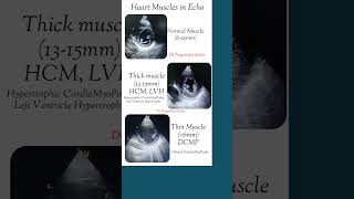 NormalThick Thin heart muscle in echo echo Shorts [upl. by Nally161]