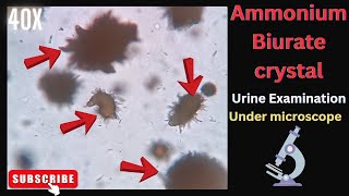 Ammonium Biurate crystal in urine  Microscopic examination  medicallabtechnologysajal6903 [upl. by Harwin]