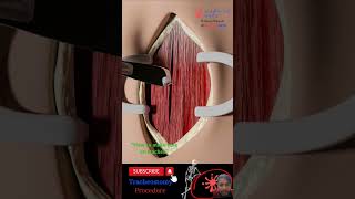 tracheostomy procedure doctor 3danimationsurgery medicalanimation viral viral short [upl. by Uzzial113]