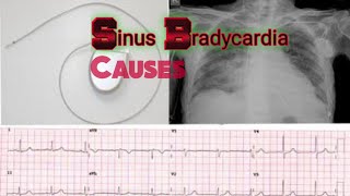 Sinus Bradycardia causes Sinus Bradycardia  medicalmnemonics786 [upl. by Elwyn281]