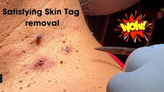 Amazing Satisfying Skin Tag Removal [upl. by Hastie]