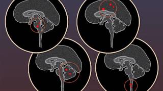 Minocycline and Onset of MS [upl. by Linnet]