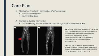 Acute Limb Ischemia [upl. by Rasure890]