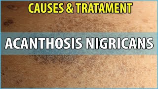 What is Acanthosis Nigricans Causes Symptoms and Treatments [upl. by Reyam53]