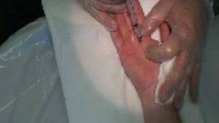 Palmar Hyperhidrosis Botox Procedure [upl. by Hance]