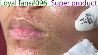 Acne Treatment Huong Da Nang 096  Loyal fans  Super product [upl. by Denney]