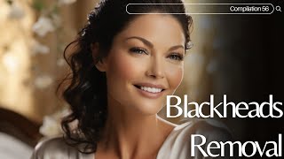 Skincare  Blackheads Removal 056 skincare skincare blackheads blackheads [upl. by Tisha352]