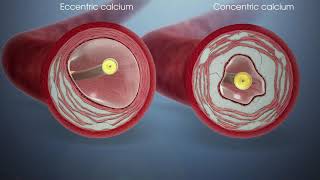 Shockwave Lithotripsy  Fortis Healthcare [upl. by Sherilyn832]