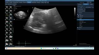 IQ 293 LUNG TUMOUR TFAST ULTRASOUND ECHOPAC ANALYSIS 3 [upl. by Grekin]