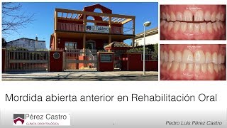 Mordida Abierta Anterior en Rehabilitación Oral [upl. by Onitnerolf]