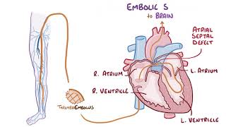 Deep vein thrombosis causes symptoms diagnosis treatment pathology [upl. by Ferneau365]