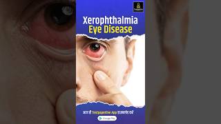 Vitamin A deficiency  xerophthalmia  Ophthalmology ophthalmology xerophthalmia VitaminA [upl. by Thera]