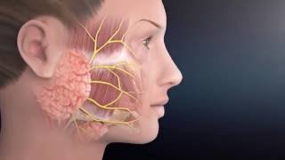 Parotid Surgery Animation  Overview of Minimally Invasive Parotidectomy [upl. by Hogan]