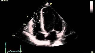 HYPERTENSIVE CARDIOMYOPATHY [upl. by Rhoads]