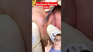 Record BLACKHEAD REMOVAL FAIL shorts [upl. by Aramen498]