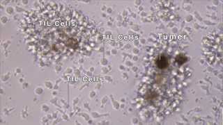 TIL  Tumor Infiltrating Immunotherapy TREATMENT [upl. by Sadiras]