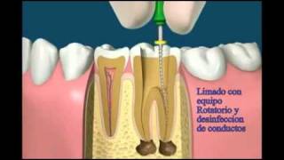 Caries endodoncia endoposte y corona [upl. by Nosduj958]