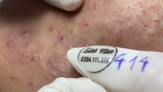 Acne treatment for Spa Linh Mun 2023 117 [upl. by Ayokahs]