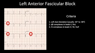 How to Read an ECG Fascicular blocks LAFB LPFB RBBB and LAFB RBBB and LPFB [upl. by Aker]