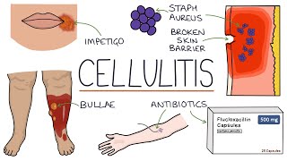 Understanding Cellulitis Skin and Soft Tissue Infections [upl. by Yedrahs]