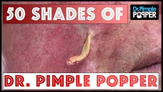 50 shades of DrPimplePopper A 1 Million Subs Special [upl. by Rickart]