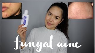 MALASSEZIA FOLLICULITISFUNGAL ACNE Tiny Forehead Bumps  My Experience and Treatment  jskavee [upl. by Orhtej]