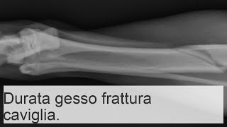 Frattura della caviglia con e senza spostamento quanto tempo bisogna camminare con il gesso [upl. by Joletta546]