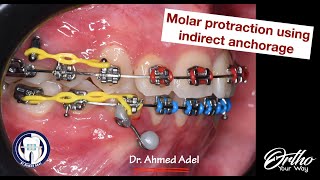 Molar protraction using miniscrewTAD indirect anchorage step by step by dr ahmed adel orthodontics [upl. by Hsan870]