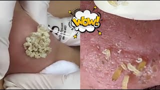 Ultimate Acne Treatment Compilation Top Tips amp Effective Solutions for Clear Skin [upl. by Yllime]