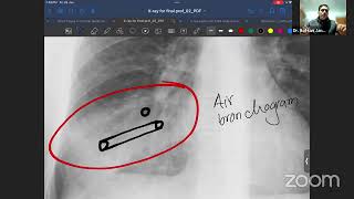 Axis Xray2  Consolidation Collapse Fibrosis Pulmonary TB Mass lesion Lung abscess [upl. by Yer624]