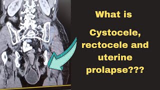 What is Cystocele and RectoceleRadiology Learning [upl. by Ennaid567]