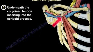 Thoracic Outlet Syndrome  Everything You Need To Know  Dr Nabil Ebraheim [upl. by Assetniuq]