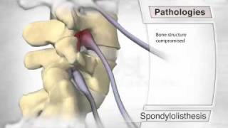 Spondylolisthesis Pathology [upl. by Davey]