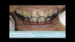 Direct Veneers  Οψεις Ρητινης [upl. by Koval]