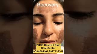 CO2quot Laser Acne scars Treatment acnetreatment pimples hydrafacial trendingreelsvideo new [upl. by Sondra]