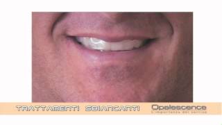 Opalescence Ultradent  Sbiancamento Dentale [upl. by Arreic853]