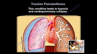 Tension Pneumothorax  Everything You Need To Know  Dr Nabil Ebraheim [upl. by Fonsie]