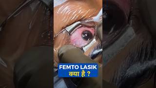 What Is FEMTO Lasik [upl. by Xet]