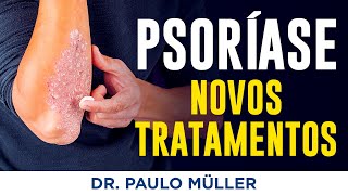 Psoríase – Novidades no Tratamento 2024 – Dr Paulo Müller Dermatologista [upl. by Oly]