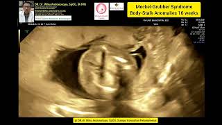 Meckel Grubber Syndrome with Body Stalk Anomalies 16 weeks [upl. by Euqinahc]