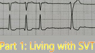 HEARTRATE of 250 Living with AVNRTSupraventricular Tachycardia SVT Part 1 [upl. by Enak]