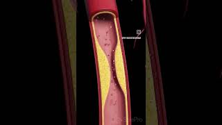 Arteriosclerosis means “hardening of the arteries” [upl. by Pfosi]