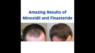 Minoxidil and Finasteride 5 Topical Solution  Before and After Result  One Month Journey [upl. by Collyer]