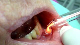 Canker Sores treatment Ozone DTA [upl. by Lekcim]