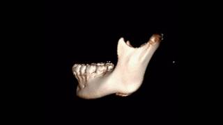 Green stick fracture of the mandibular condylar neck [upl. by Medor295]